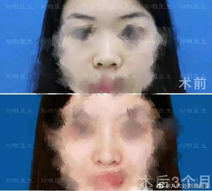 劉暾隆鼻案例