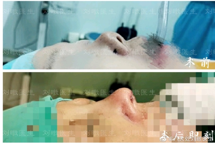 劉暾鼻修復案例