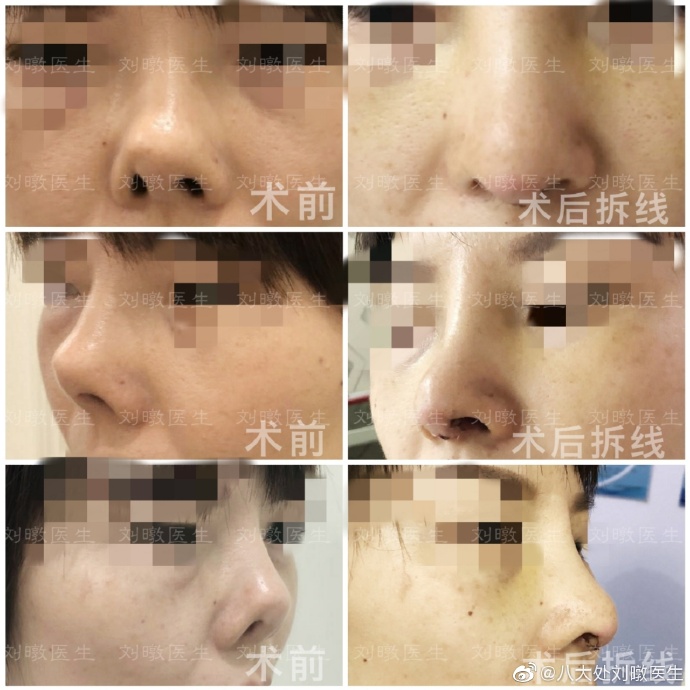 劉暾鼻綜合修復