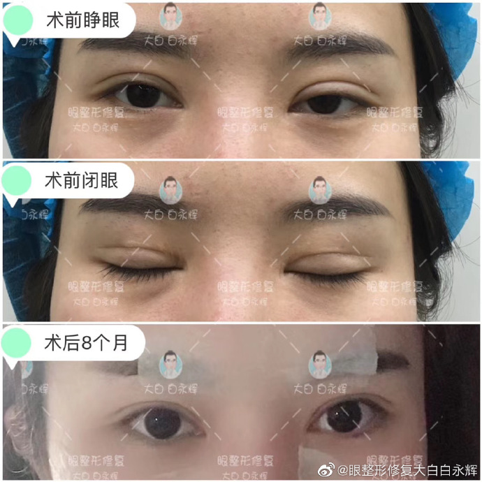 白永輝雙眼皮修復(fù)案例