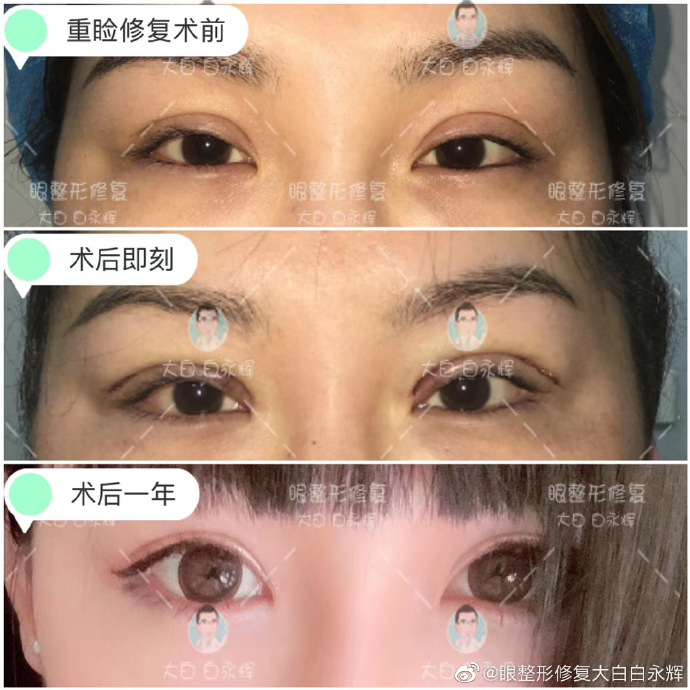 白永輝雙眼皮修復(fù)案例