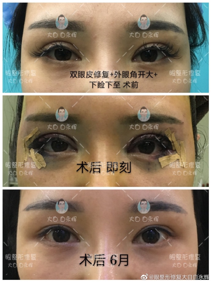 白永輝雙眼皮修復(fù)案例