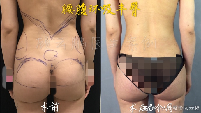 顧云鵬豐臀案例