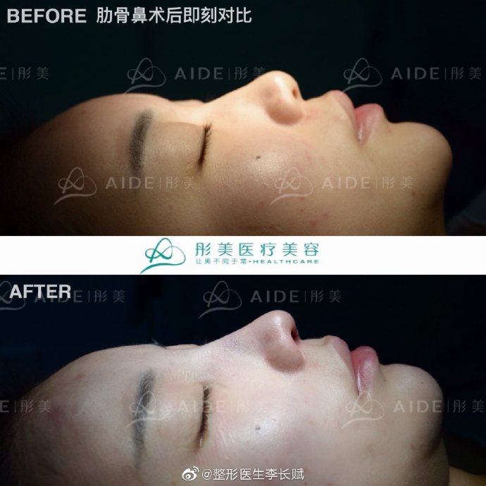 李長(zhǎng)賦鼻綜合案例