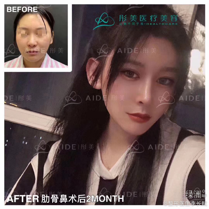 李長(zhǎng)賦鼻綜合案例