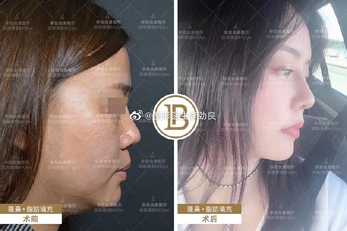 李勁良鼻綜合案例