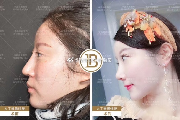 李勁良鼻修復(fù)案例