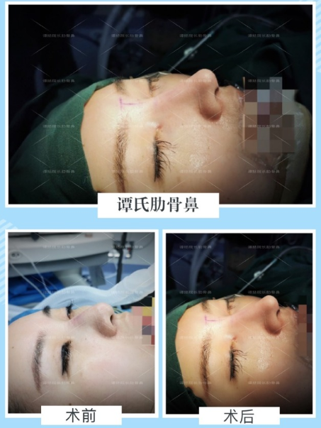 譚拯醫(yī)生怎么樣？譚拯做鼻子好不好？