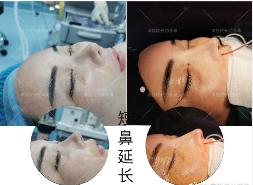 譚拯醫(yī)生怎么樣？譚拯做鼻子好不好？