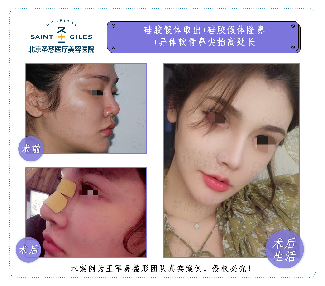 王軍鼻修復案例