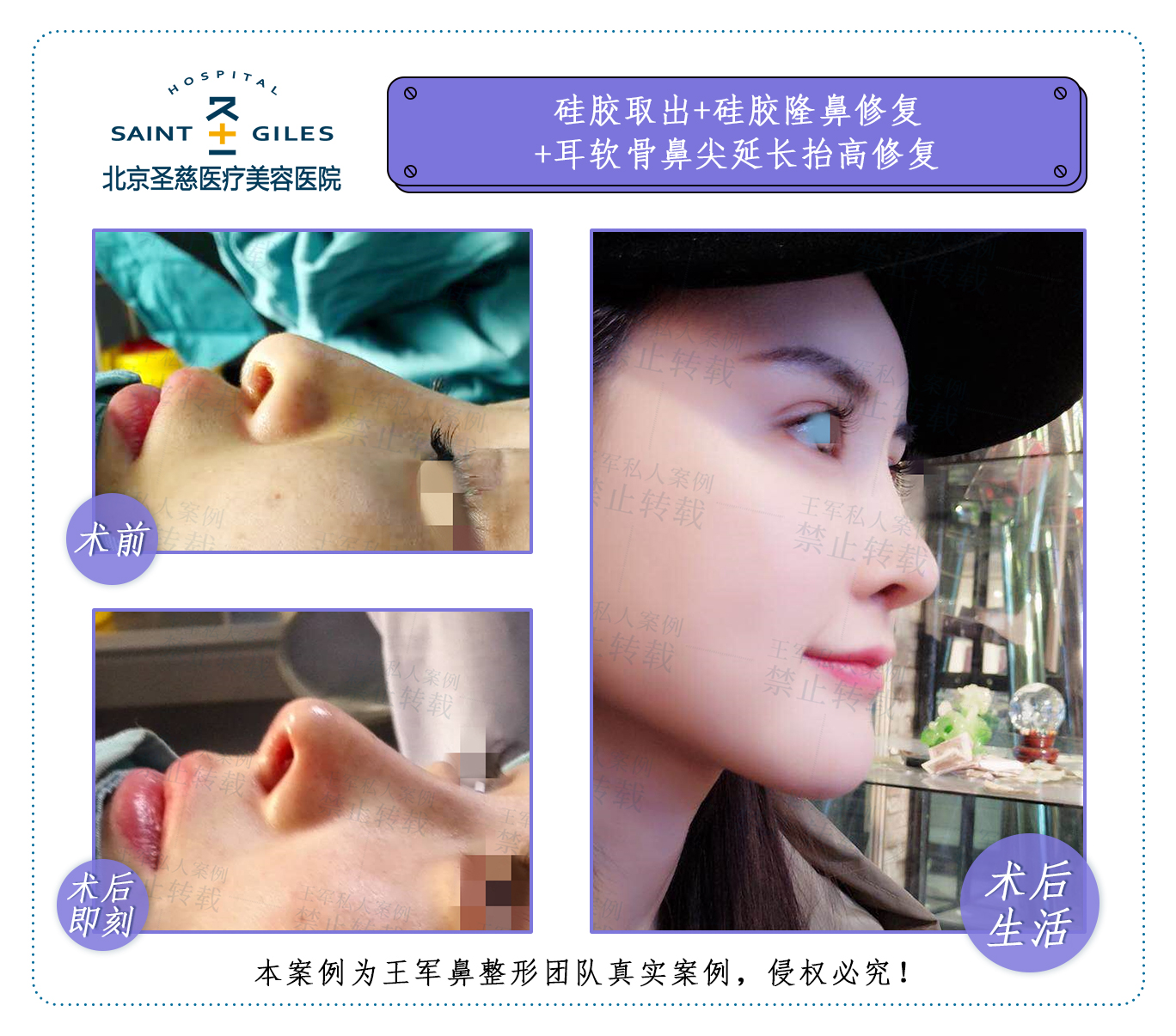 王軍鼻修復案例