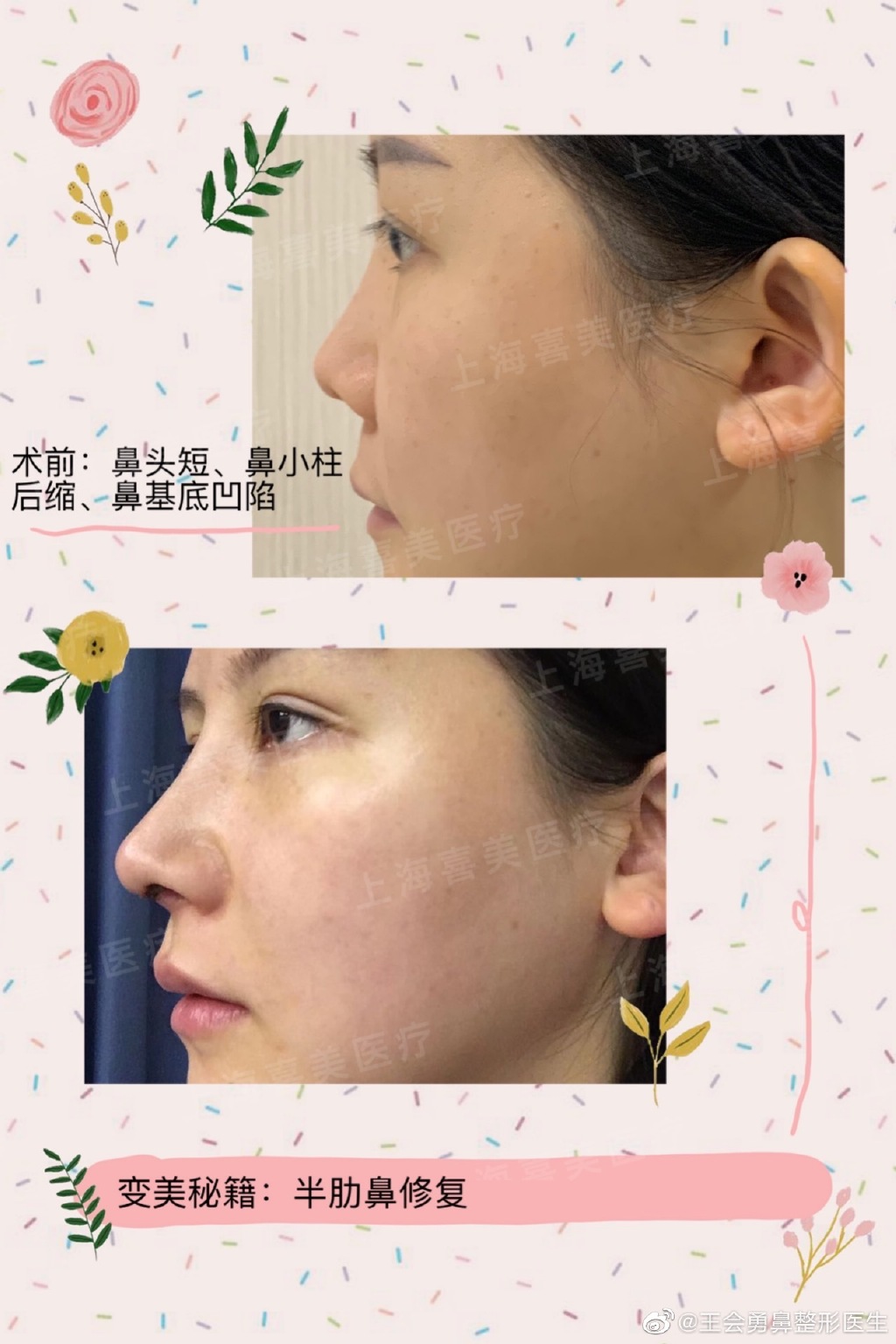 王會(huì)勇鼻修復(fù)案例