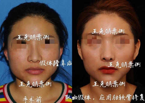 王克明鼻修復案例