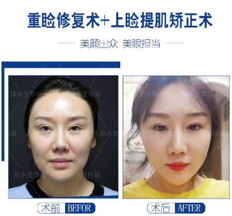 鄭永生眼修復案例