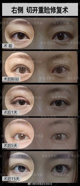 鄭永生眼修復案例