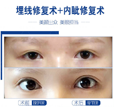 鄭永生雙眼皮修復案例