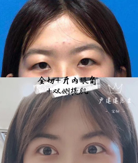 盧建建雙眼皮案例