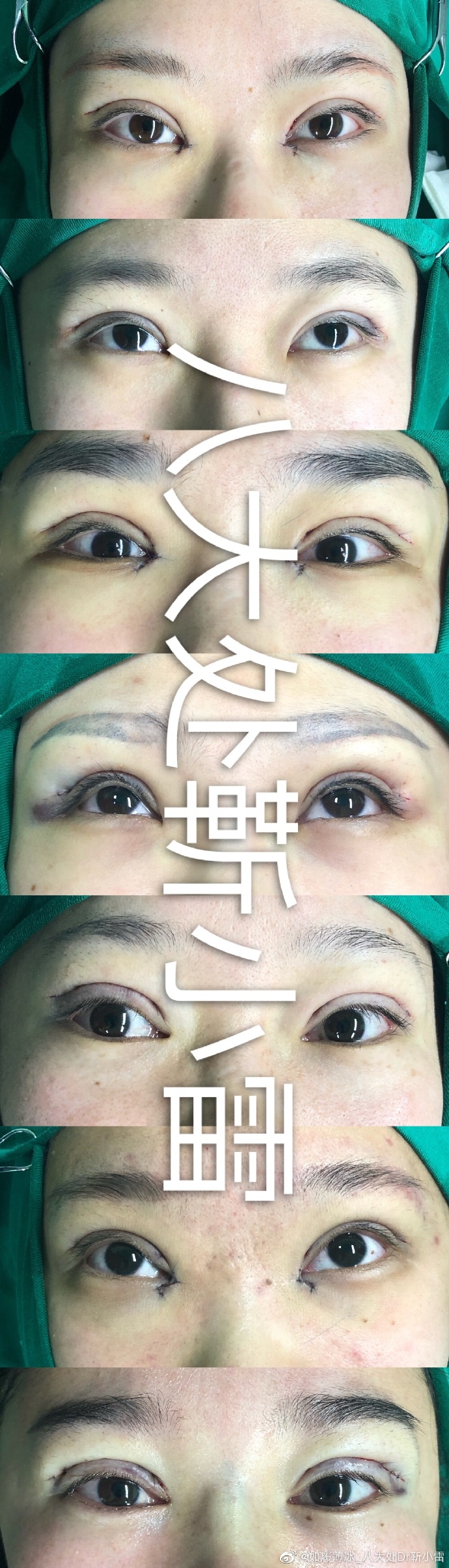 靳小雷眼修復案例