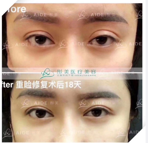 劉風卓眼修復案例