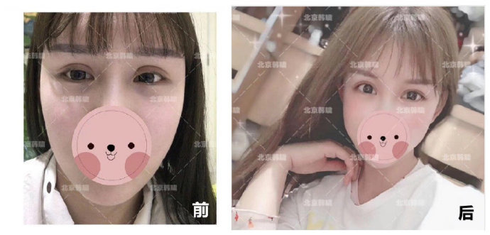 白永輝眼修復案例