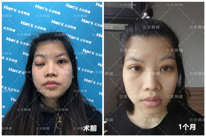 白永輝眼修復案例