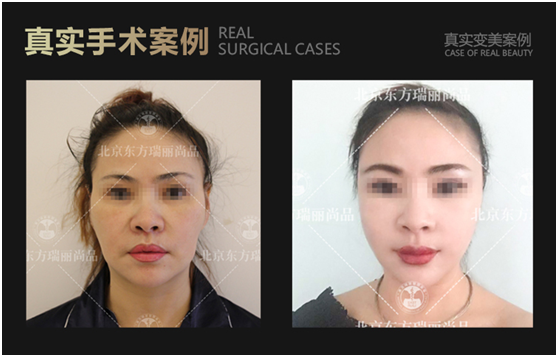 李曉東面部提升案例