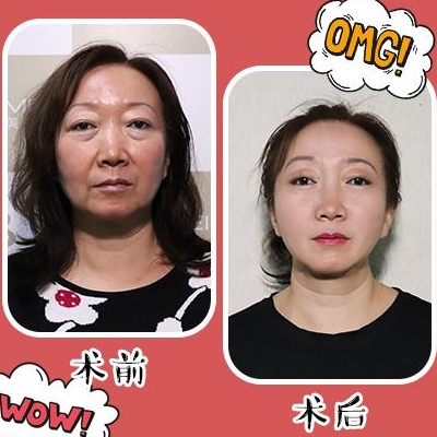 孫瑋駿面部提升案例