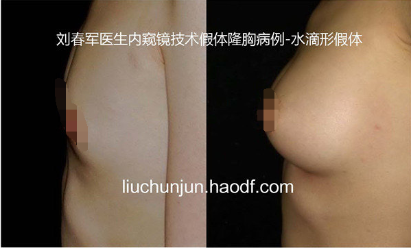 劉春軍豐胸案例