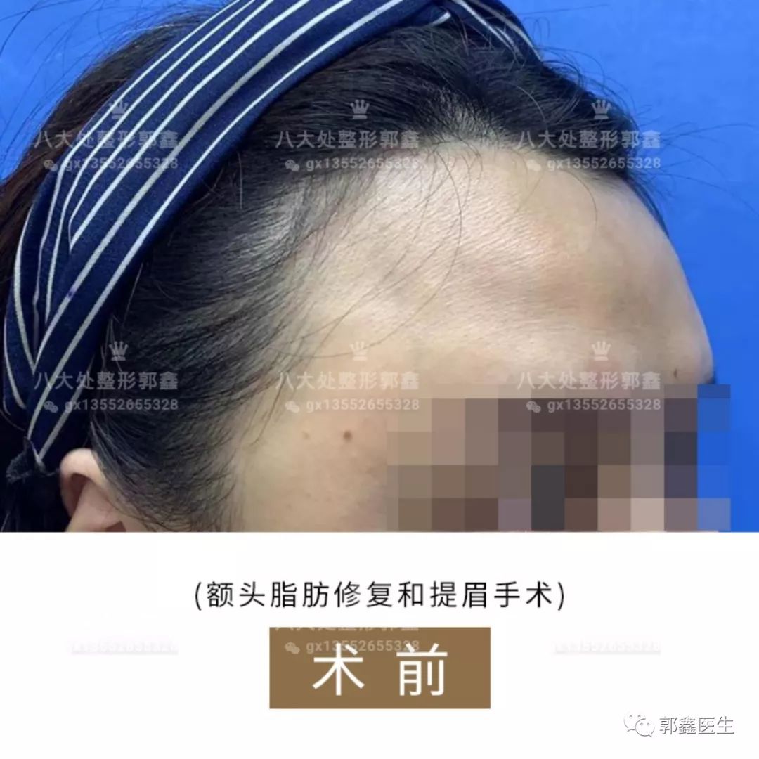 脂肪修復(fù)案例