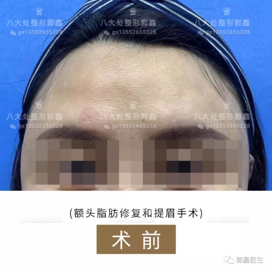 郭鑫脂肪修復(fù)案例