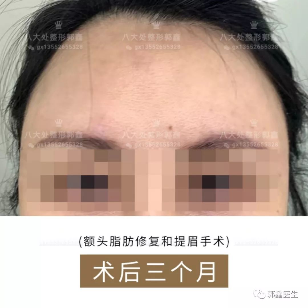郭鑫脂肪修復(fù)案例