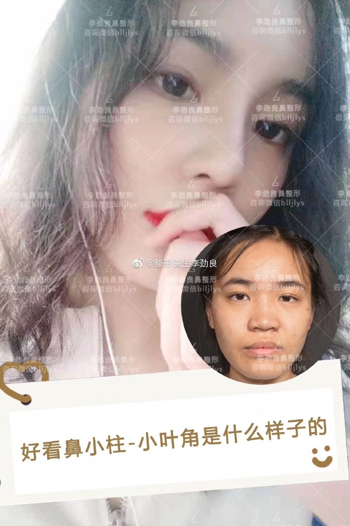 李勁良鼻綜合案例