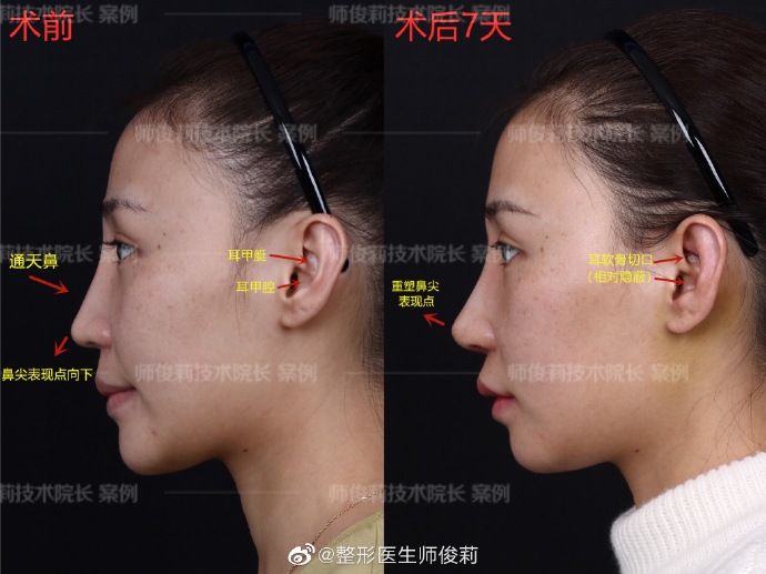 師俊莉鼻修復(fù)案例