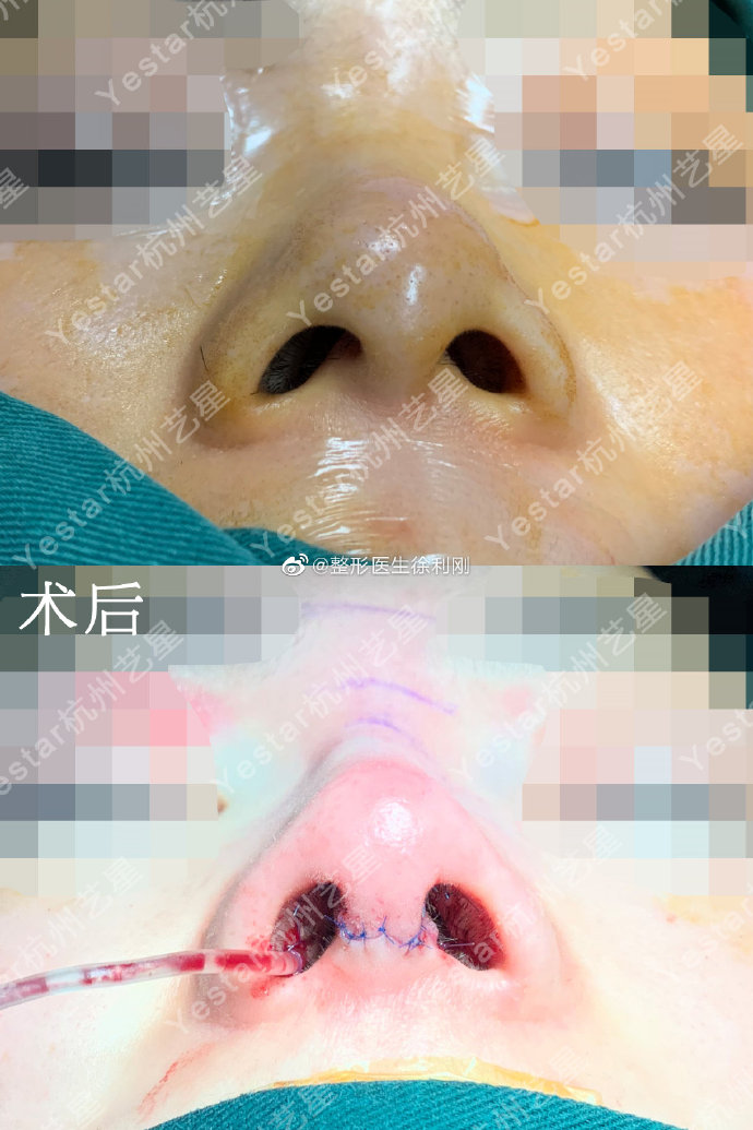 徐利剛鼻修復案例