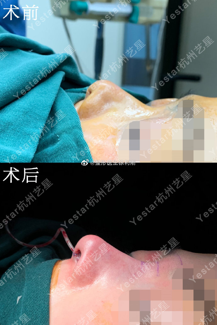 徐利剛鼻修復案例