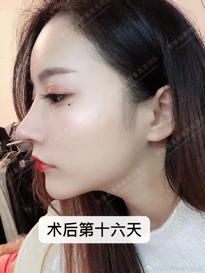 李保鍇鼻修復案例