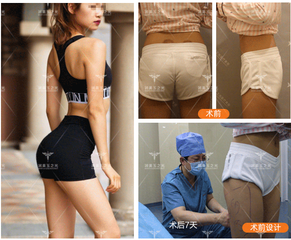 王明利豐臀案例