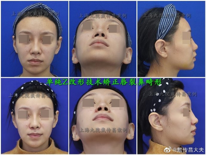 戴傳昌鼻修復案例