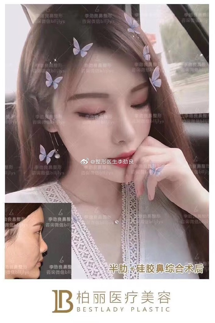 李勁良鼻綜合案例