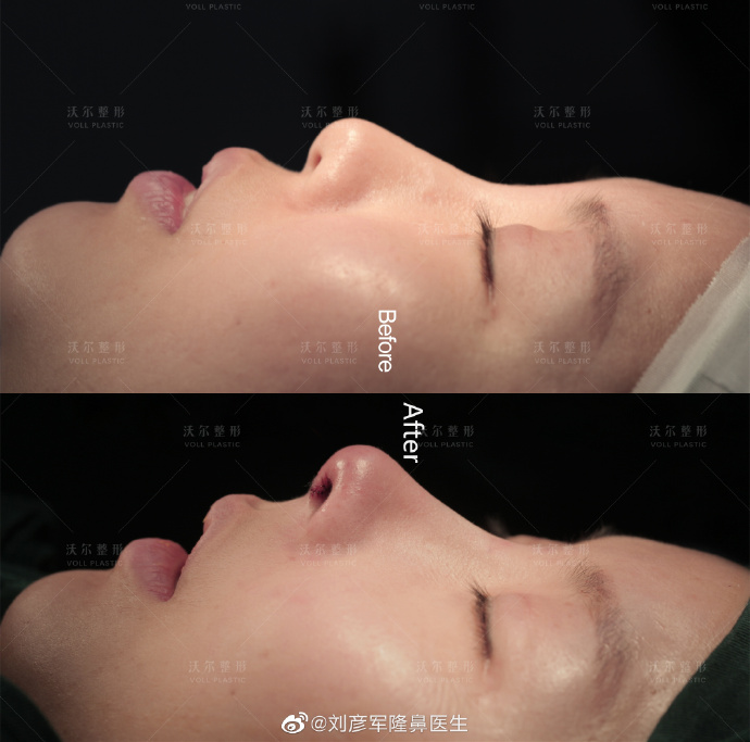 劉彥軍鼻綜合案例