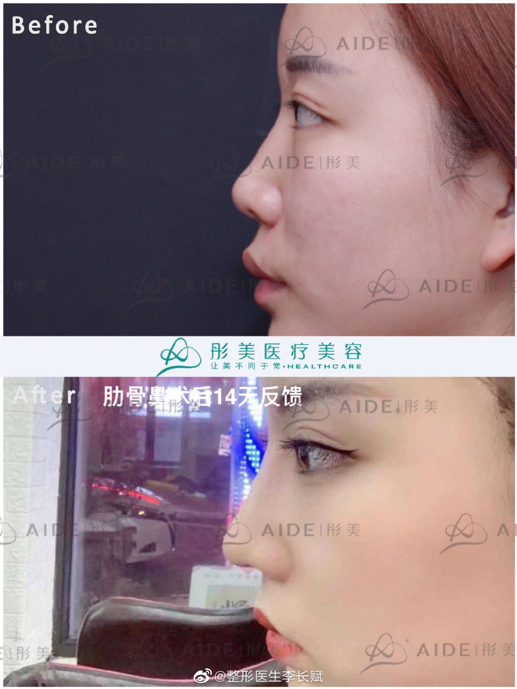 李長賦鼻綜合案例