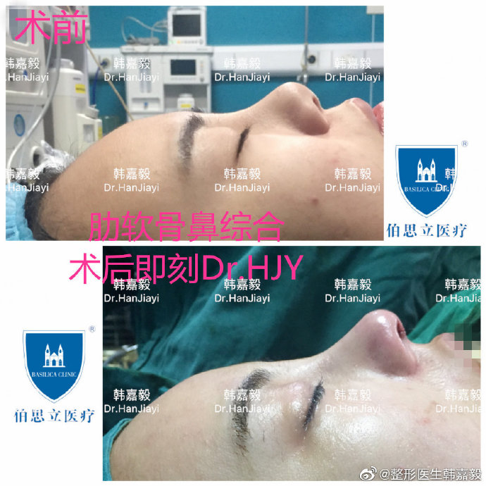 韓嘉毅鼻綜合案例
