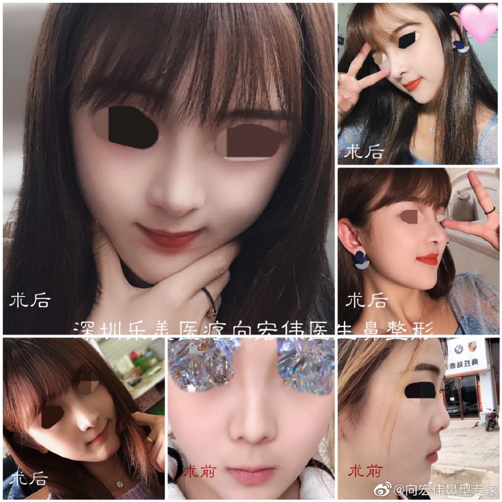 向宏偉鼻綜合案例