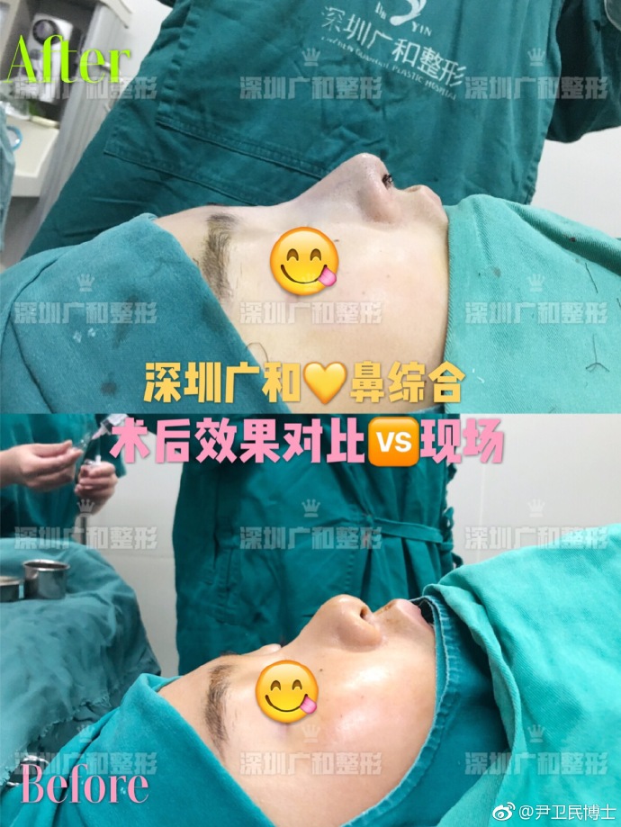 尹衛(wèi)民鼻綜合案例