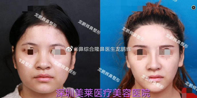 龍鵬輝鼻綜合案例