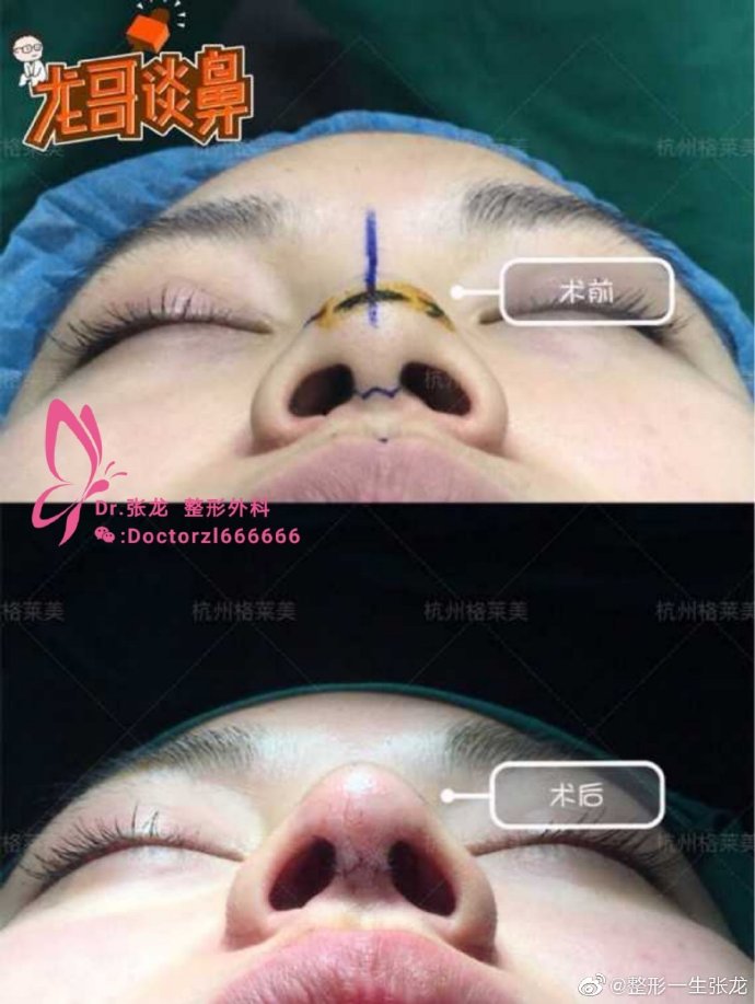 張龍鼻綜合案例