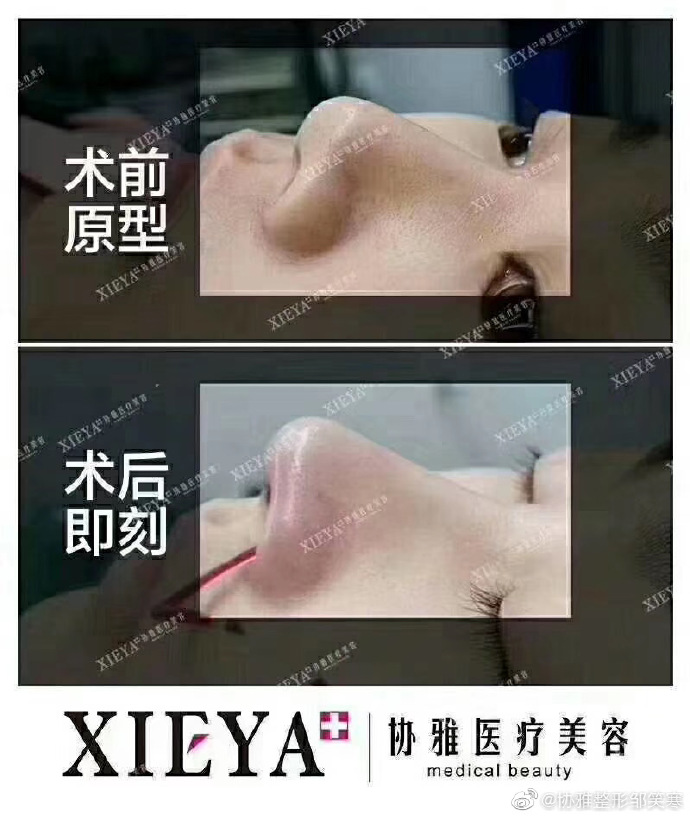鄒笑寒鼻綜合案例