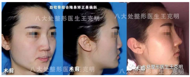 王克明鼻修復案例
