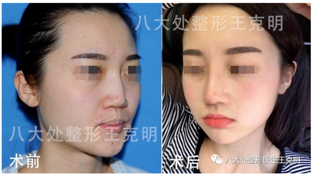 王克明鼻修復案例