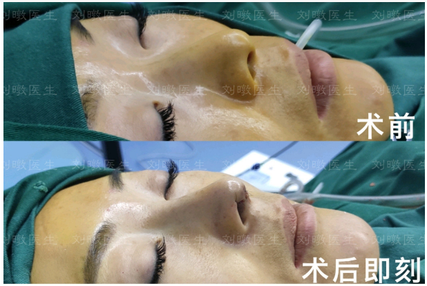 劉暾鼻修復案例